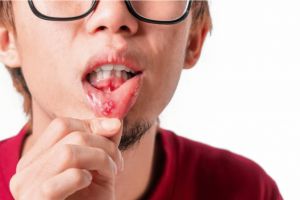 Recette Maladie de Behçet , Comment les ulcères buccaux peuvent signaler une menace vasculaire plus profonde