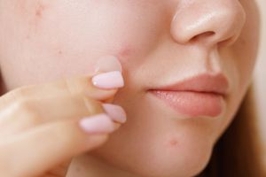 Recette How Do Pimple Patches Work? 3 Ways They Help Blemishes Heal
