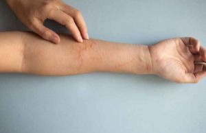 Recette Piqûre d’insecte qui ne disparaît pas : que faire et quand s’inquiéter ?