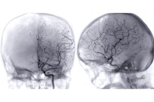 Recette Rupture d’anévrisme cérébral : quelles sont vos chances de survie ?