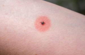 Recette 7 Tips to Avoid Tick Bites and Prevent Tick-Borne Disease