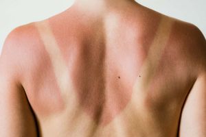 Recette 10 Ways to Treat a Sunburn at Home