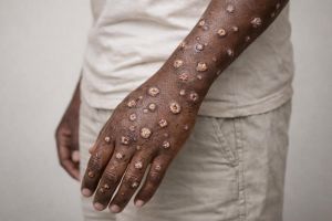 Recette Alerte au Mpox à Madagascar