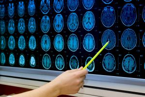 Recette What Causes Huntington’s Disease?