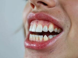 Recette L’impact du stress sur la santé bucco-dentaire